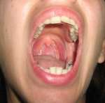 Biting the inside of your mouth